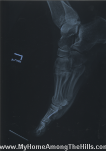 X-ray of my foot