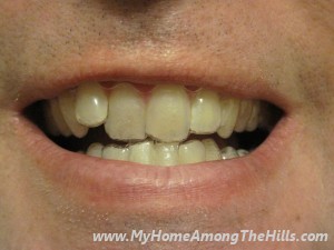 My Invisalign aligners!