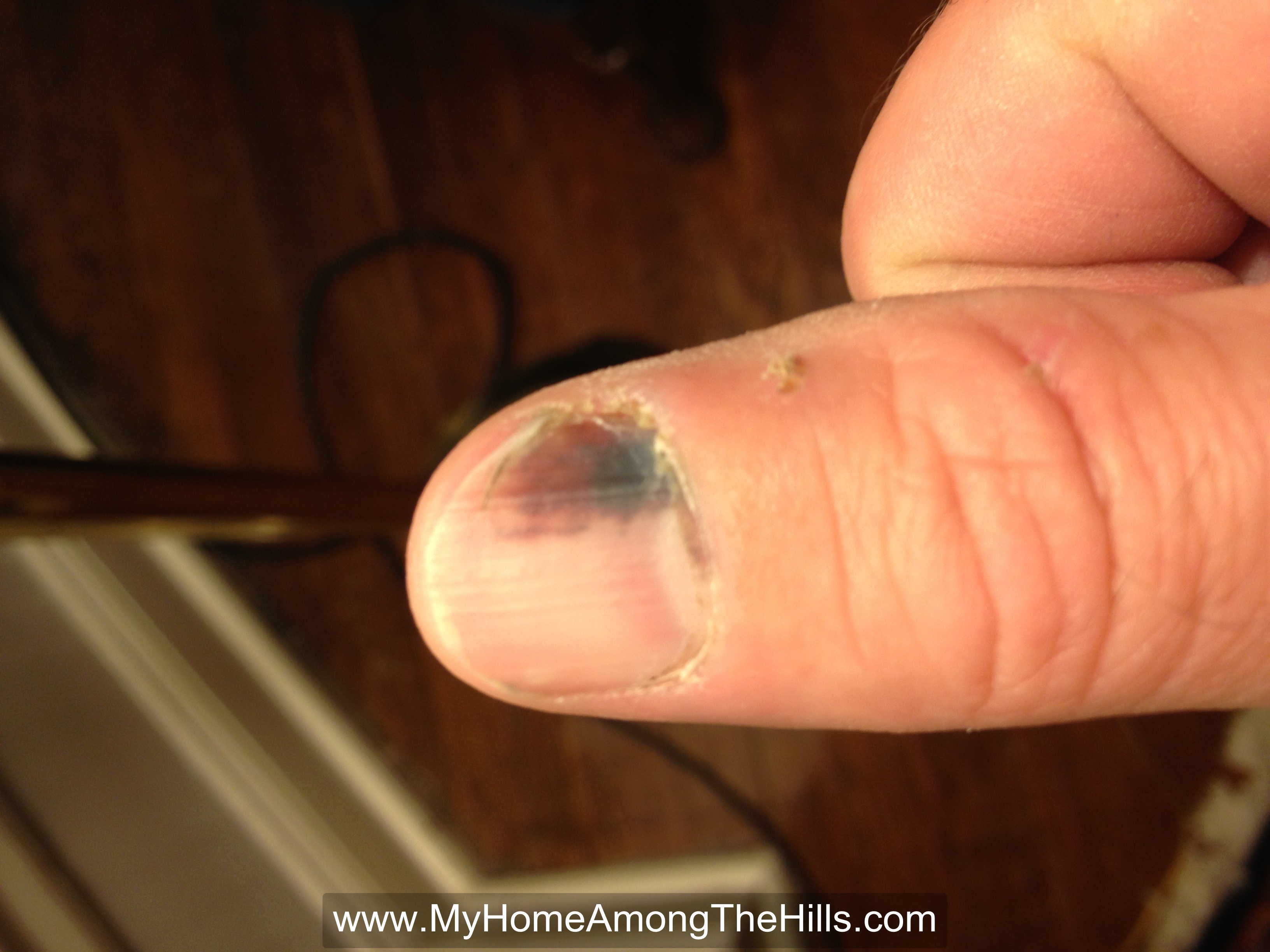 Angle grinder + finger = bad My Home Among The Hills